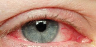 Những điều nên biết về bệnh đau mắt đỏ