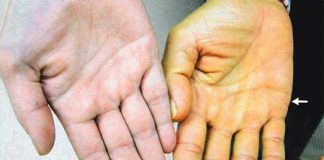 Nhìn da đoán bệnh gan