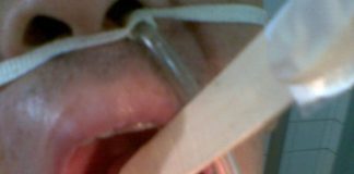 Cận cảnh thuốc lá tàn phá dữ dội sức khỏe răng miệng