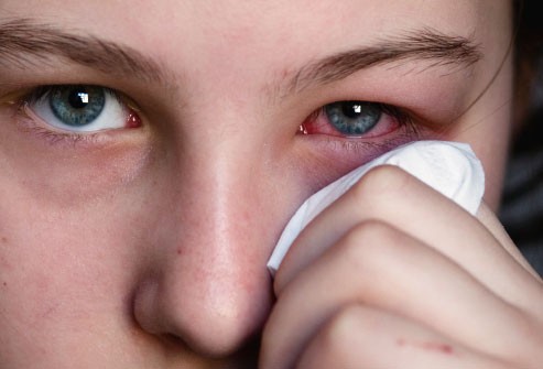 Bệnh đau mắt đỏ: nguyên nhân, phòng và trị bệnh đau mắt hiệu quả