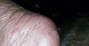 Người phụ nữ đột nhiên mọc 3 chiếc sừng lớn từ lòng bàn chân