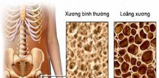 Hiểu đúng để phòng ngừa bệnh xốp xương