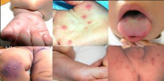 Dấu hiệu, cách phòng, chữa trị bệnh tay chân miệng