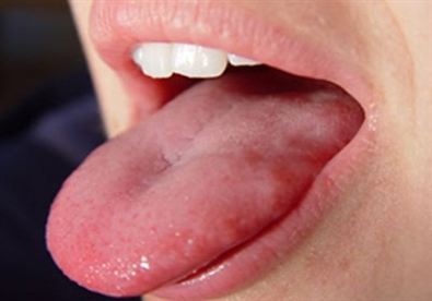 Đoán bệnh qua những đặc điểm bất thường của lưỡi - 2