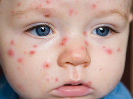 Những bệnh ‘kinh khủng’ bạn sẽ chỉ gặp 1 lần trong đời-1