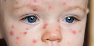 Những bệnh ‘kinh khủng’ bạn sẽ chỉ gặp 1 lần trong đời-1