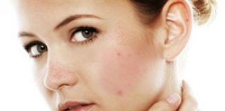 Phải làm sao để không có mụn trên khuôn mặt?