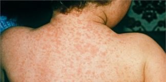 Biện pháp khẩn cấp giúp phòng tránh bệnh sởi