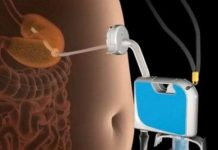 Giảm cân bằng máy hút thức ăn