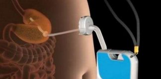 Giảm cân bằng máy hút thức ăn