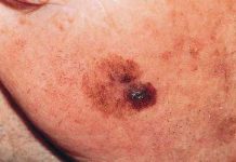 Anh phát minh 2 phương thuốc mới điều trị u hắc tố Anh phát minh 2 phương thuốc mới điều trị u hắc tố