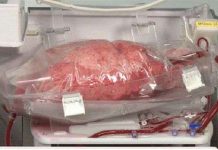 Thiết bị duy trì “sự sống” nội tạng bên ngoài cơ thể