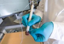 Chiếc bút phát hiện ung thư trong 10 giây Chiếc bút phát hiện ung thư trong 10 giây