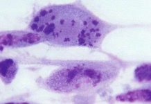 Hai phần ba dân số thế giới nhiễm virus lây qua đường tình dục Hai phần ba dân số thế giới nhiễm virus lây qua đường tình dục