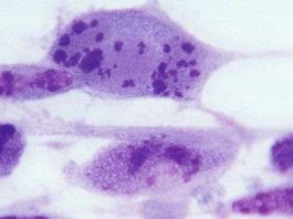 Hai phần ba dân số thế giới nhiễm virus lây qua đường tình dục