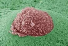 Khối u hình thành di căn như thế nào?