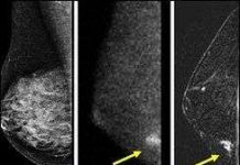 Thiết bị siêu âm 3D giúp phát hiện sớm ung thư vú