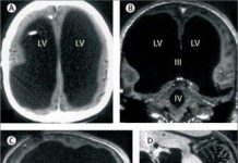 Người đàn ông "không có não" mà vẫn sống thách thức giới khoa học