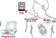 Thiết bị cảnh báo đau tim