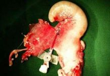 Mang thai sau khi cấy ghép tử cung