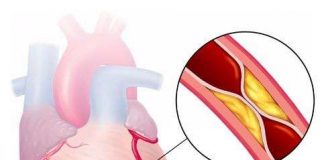 Thiết bị Kardiosens cảnh báo sớm nhồi máu cơ tim