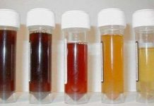 Cách đoán bệnh từ màu nước tiểu