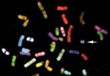 Hội chứng Down giúp chống lại bệnh ung thư