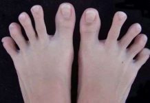 Đố bạn phân biệt 3 ngón chân bất trị ai cũng có