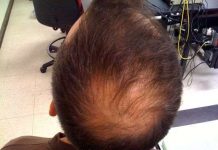 Nang lông nhân tạo giúp điều trị chứng rụng tóc