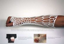 Cách mới điều trị gãy xương: Bó bột bằng khung vật liệu in 3D