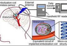 Cấy ghép ăng ten không dây để theo dõi chứng phình động mạch não