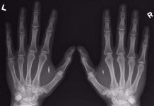 4 thiết bị cấy ghép cực nhỏ biến bạn thành siêu nhân 4 thiết bị cấy ghép cực nhỏ biến bạn thành siêu nhân