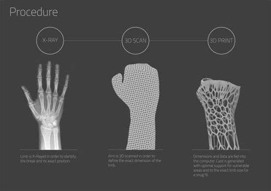 Cách mới điều trị gãy xương: Bó bột bằng khung vật liệu in 3D