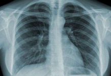 Kiểm tra lao phổi không cần chụp X-quang nhờ thiết bị mới