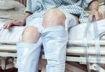 "Vớ" chống đông máu dành cho bệnh nhân đột quỵ