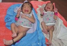 Hai bé sinh đôi từ hai tử cung khác nhau