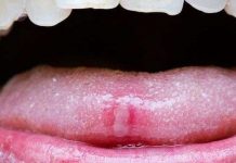 Nhiều người rất hay cắn nhầm phải lưỡi và lý do là...