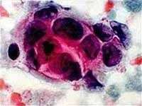 “Bom” nano tiêu diệt ung thư “Bom” nano tiêu diệt ung thư