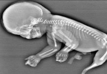 Thai nhi mọc đuôi như nàng tiên cá trong bụng mẹ Thai nhi mọc đuôi như nàng tiên cá trong bụng mẹ