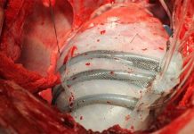 Robot trợ giúp bệnh nhân suy tim qua cơn nguy kịch