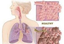 Sử dụng tế bào gốc chữa bệnh phổi tắc nghẽn