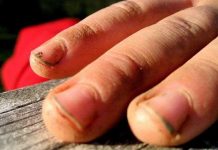 Những cáu bẩn màu ghi dưới móng tay đến từ đâu?
