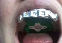 Chiếc MP3 gắn trong miệng