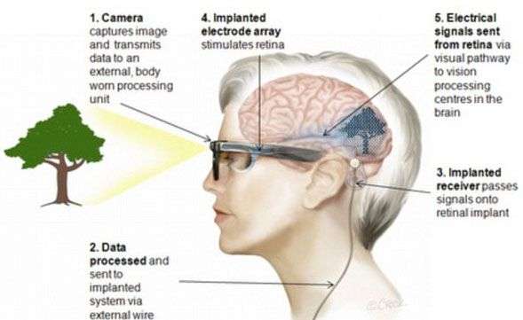 Mắt điện tử: thêm hy vọng sáng mắt cho người mù