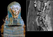 Người cổ đại cũng mắc ung thư