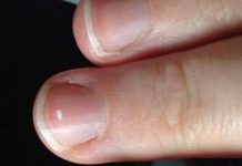 Tại sao móng tay có đốm trắng, lí do thật đơn giản