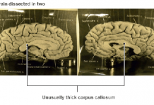 Những chuyện chưa kể về bộ não Einstein